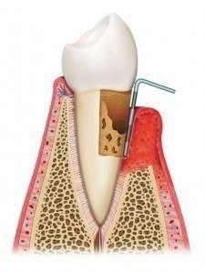 Image showing how gum disease affects tooth health.